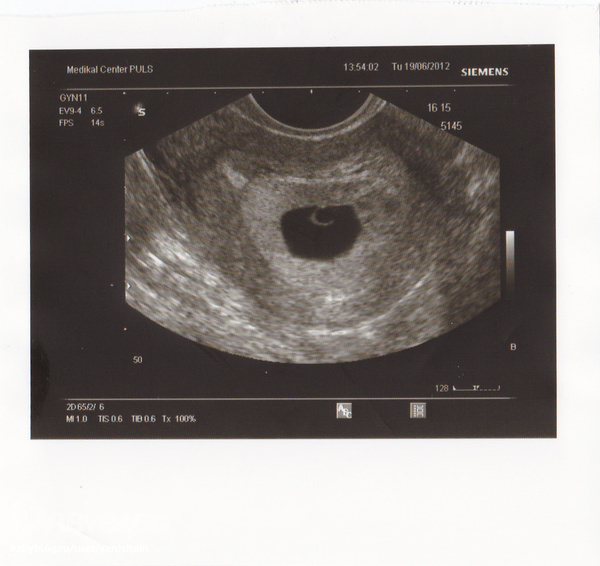 7 недель желточный. Анэмбриония на 6 неделе беременности. Анэмбриония 7 недель беременности.