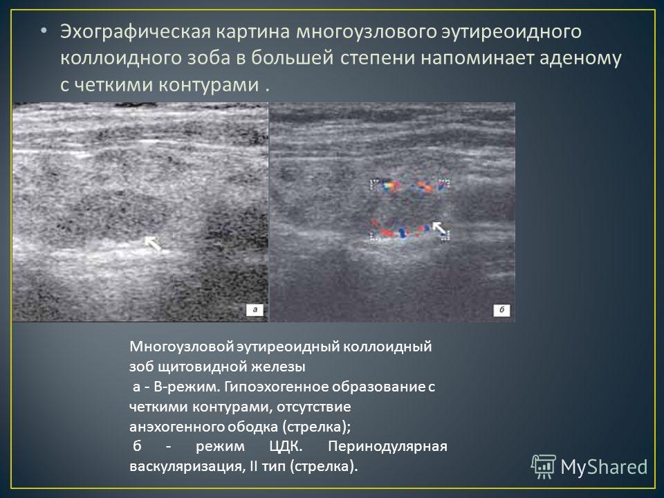 Образования в щитовидной железе. Аденома паращитовидной железы УЗИ картина. Гиперэхогенный узел щитовидной железы на УЗИ. Губчатый узел щитовидной железы на УЗИ. Гиперэхогенный узел в щитовидной железе УЗИ.