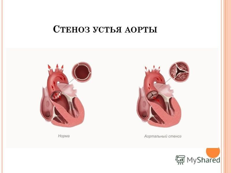 Аортальный стеноз что это такое. Врожденный аортальный стеноз. Аортальный стеноз этиология. Стеноз устья аорты и аортальный стеноз. Стеноз аортального клапана гемодинамика.