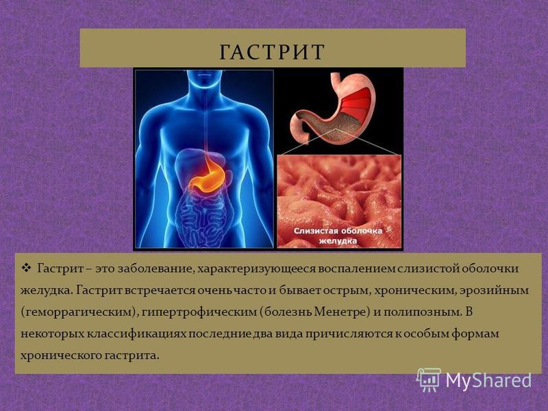 Острый гастрит клиническая картина