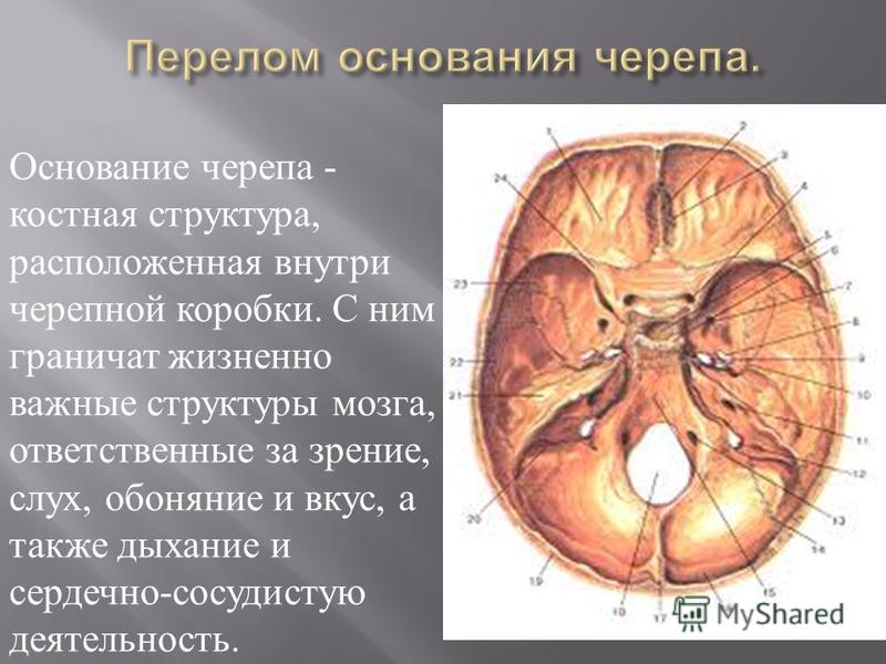 Типичное проявление перелома основания черепа