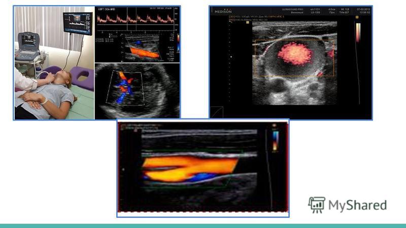 Как делают узи сосудов головы и шеи показать фото