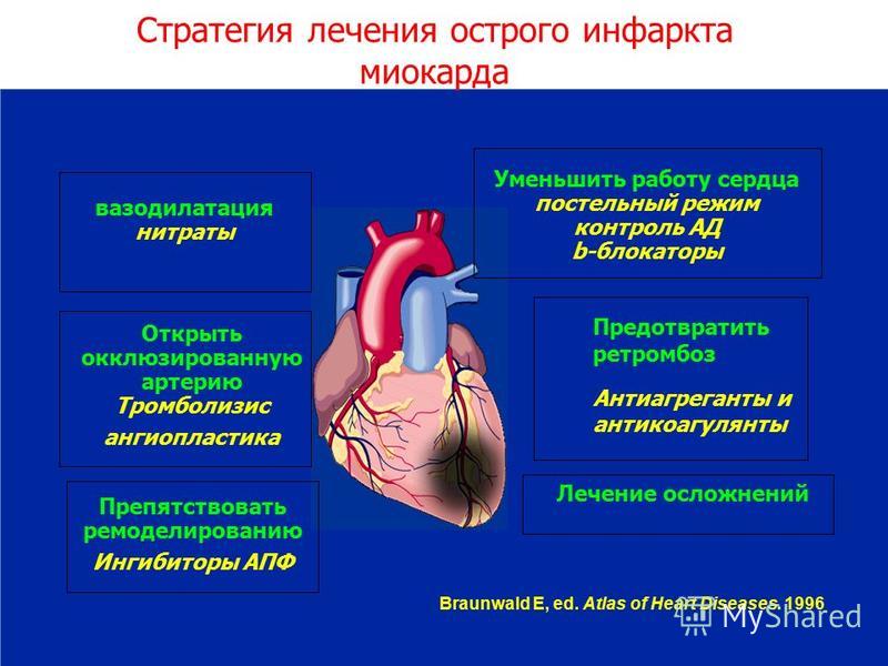 Оим это. ИБС инфаркт миокарда клиника. Главный признак инфаркта миокарда. Симптоматика острого инфаркта миокарда. Острый инфаркт миокарда сердце.