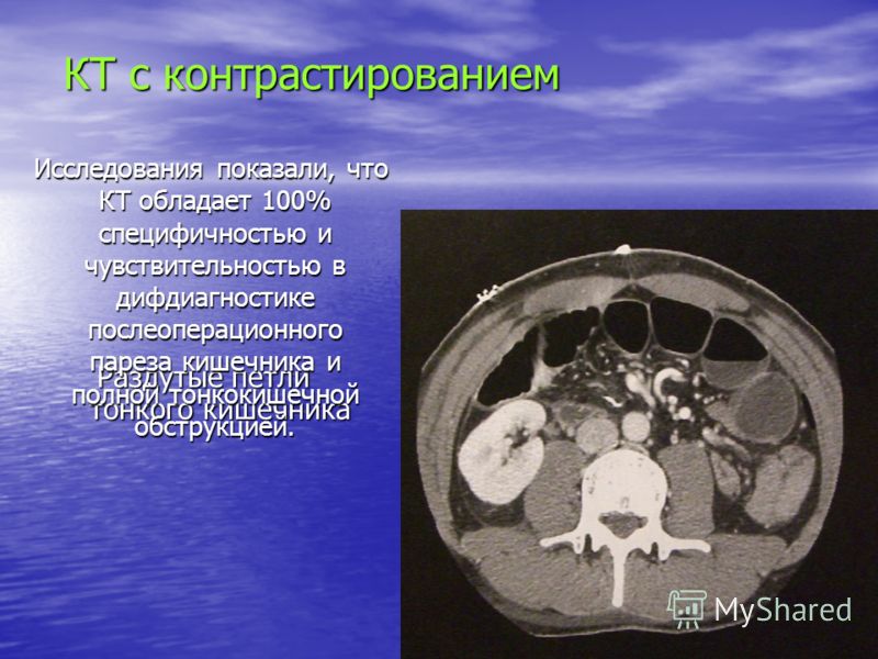 Парез кишечника презентация