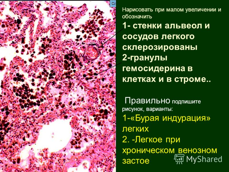 Хроническое венозное полнокровие печени микропрепарат рисунок