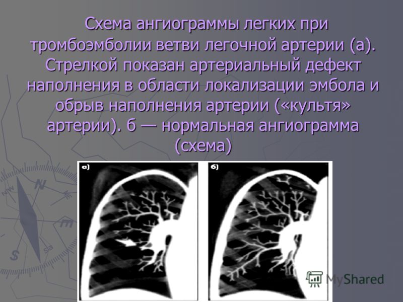 Тромбоэмболия ветвей легочной артерии