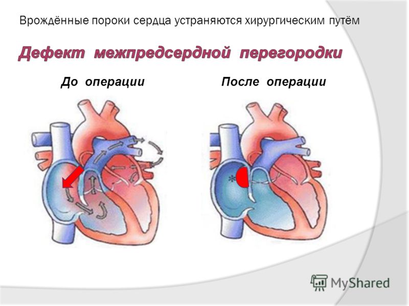 Презентация на тему приобретенный порок сердца