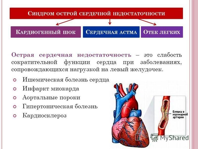 Преимущественное поражение сердца без застойной сердечной. Острая сердечная недостаточность это кратко. Причины развития острой сердечной недостаточности. Для острой сердечной недостаточности характерно. ИБС хроническая сердечно легочная недостаточность.