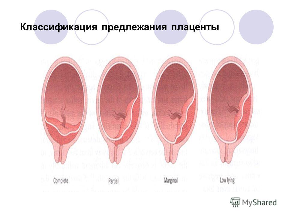 Предлежание плаценты плацента поднялась