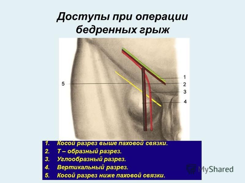 Бедренная грыжа картинки