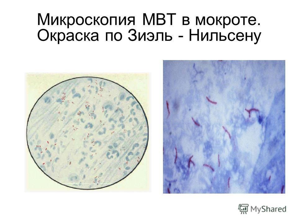 Микроскопия это. Микроскопия МБТ по Цилю-Нильсену. Спирали Куршмана микроскопия. Микроскопия мокроты эпителий: единично. Микроскоп я мокро ы при МБТ.