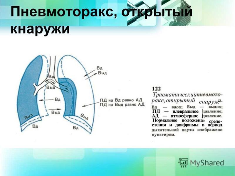 Пневмоторакс презентация. Открытый пневмоторакс презентация. Открытый пневмоторакс диагностика.