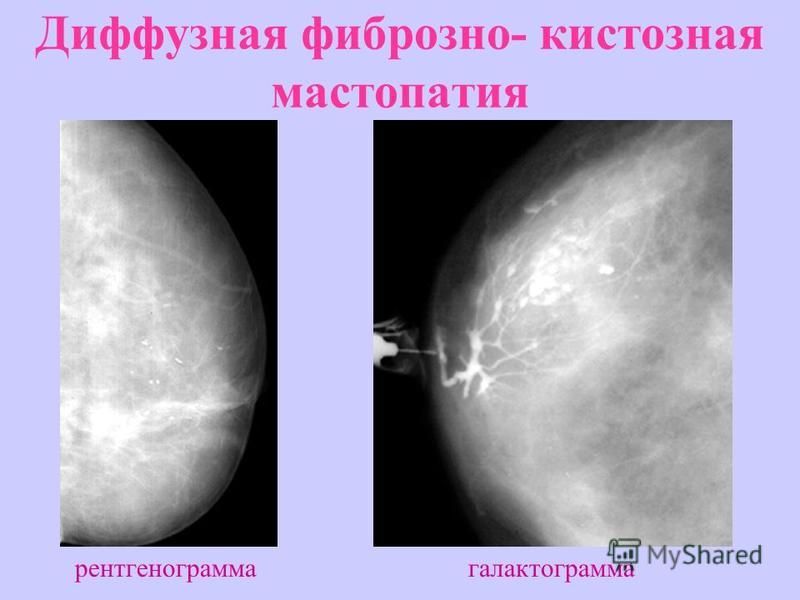 Диффузно фиброзно кистозная изменения. Мастопатия молочной железы маммограмма. Диффузная фиброзно-кистозная мастопатия. Диффузная кистозная мастопатия фиброзно-кистозная мастопатия. Диффузная ФКМ молочных желез что это.