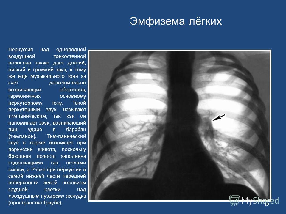 Эмфизема легких симптомы. Легочное сердце рентген признаки. Хроническое легочное сердце рентгенограмма. Легочное сердце на рентгенограмме. Хроническое легочное сердце рентген.