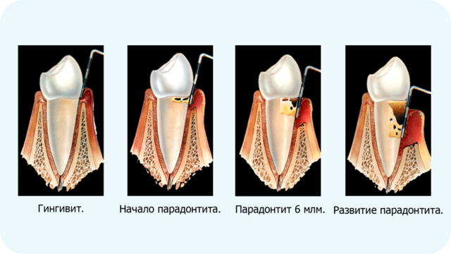 Классификация гингивита. Атрофический гингивит формы. По распространённости парадонтит.