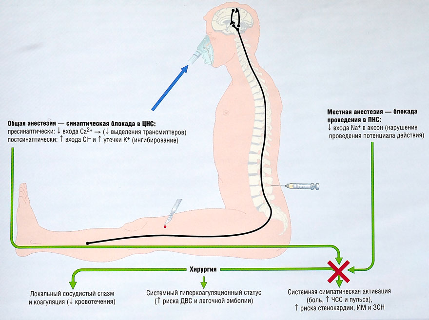 Местная анестезия схема