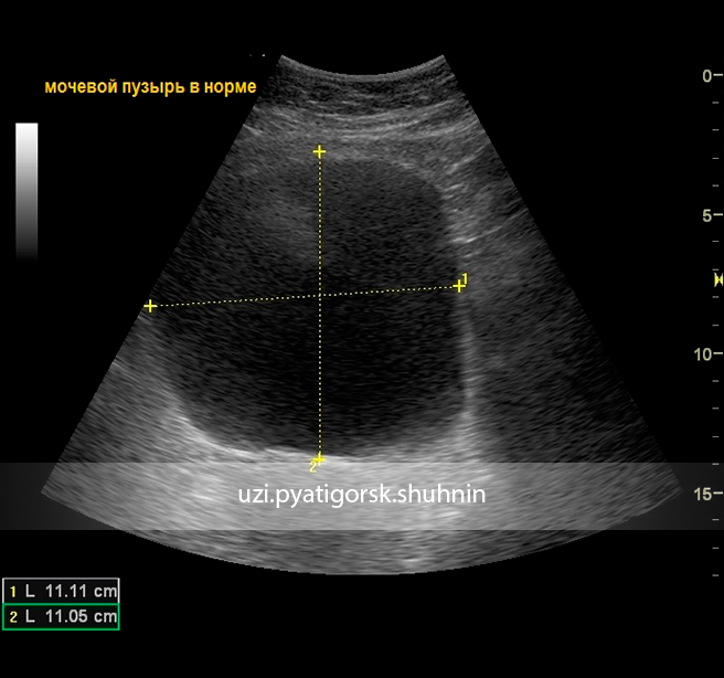 Трансабдоминальное узи. УЗИ мочевого пузыря норма. Трансабдоминальное УЗИ мочевого пузыря. УЗИ мочевого пузыря трансабдоминально. Ультрасонография мочевого пузыря.