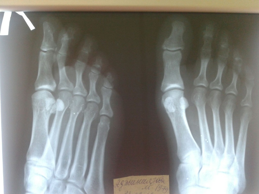 Ногтевой фаланги пальца ноги. Перелом основной фаланги 1 пальца стопы рентген. Перелом большого пальца на ноге рентген фаланга. Перелом 1 пальца стопы на рентгене. Перелом фаланги 5 пальца стопы рентген.