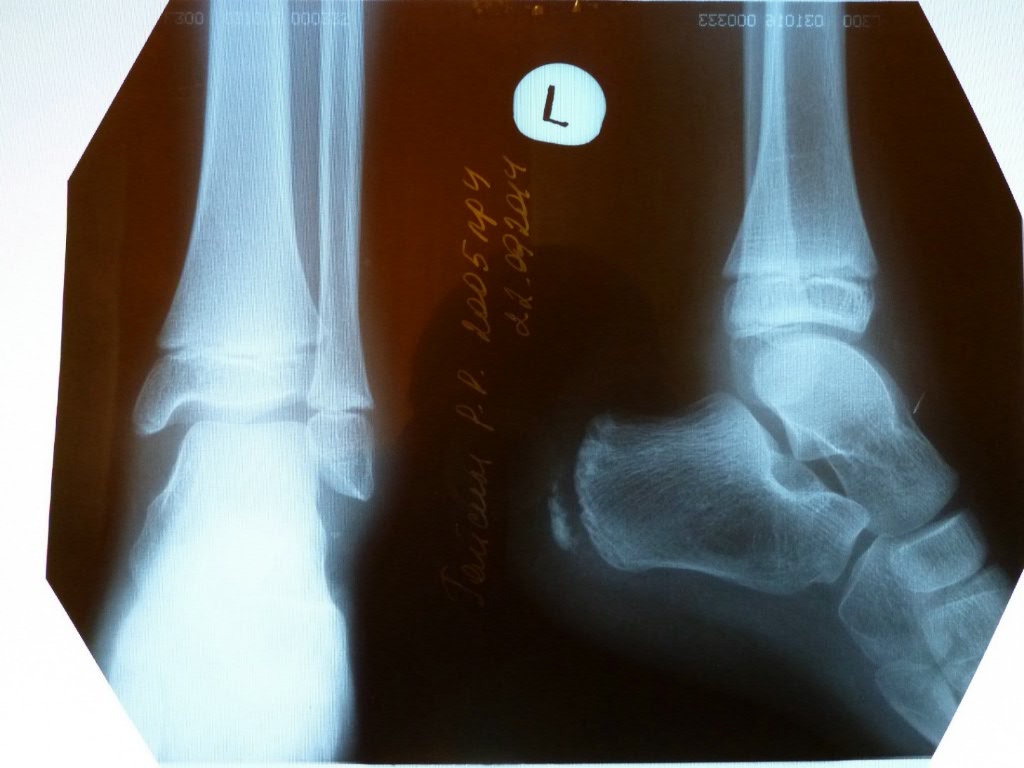 Лодыжка на ноге где находится у человека фото перелом