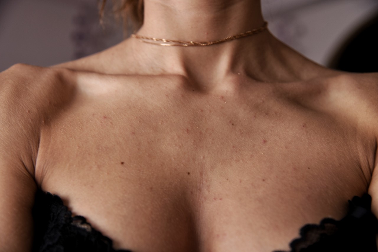 сыпь на шее на груди у женщин (120) фото