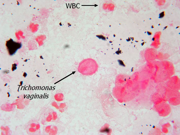 Трихомонады в мазке у женщин фото