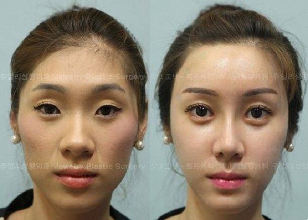 Изменение формы глаза. Операция сангапури. Блефаропластика-сангапури (сингапури). Пластика азиатских век. Пластика азиатских глаз.