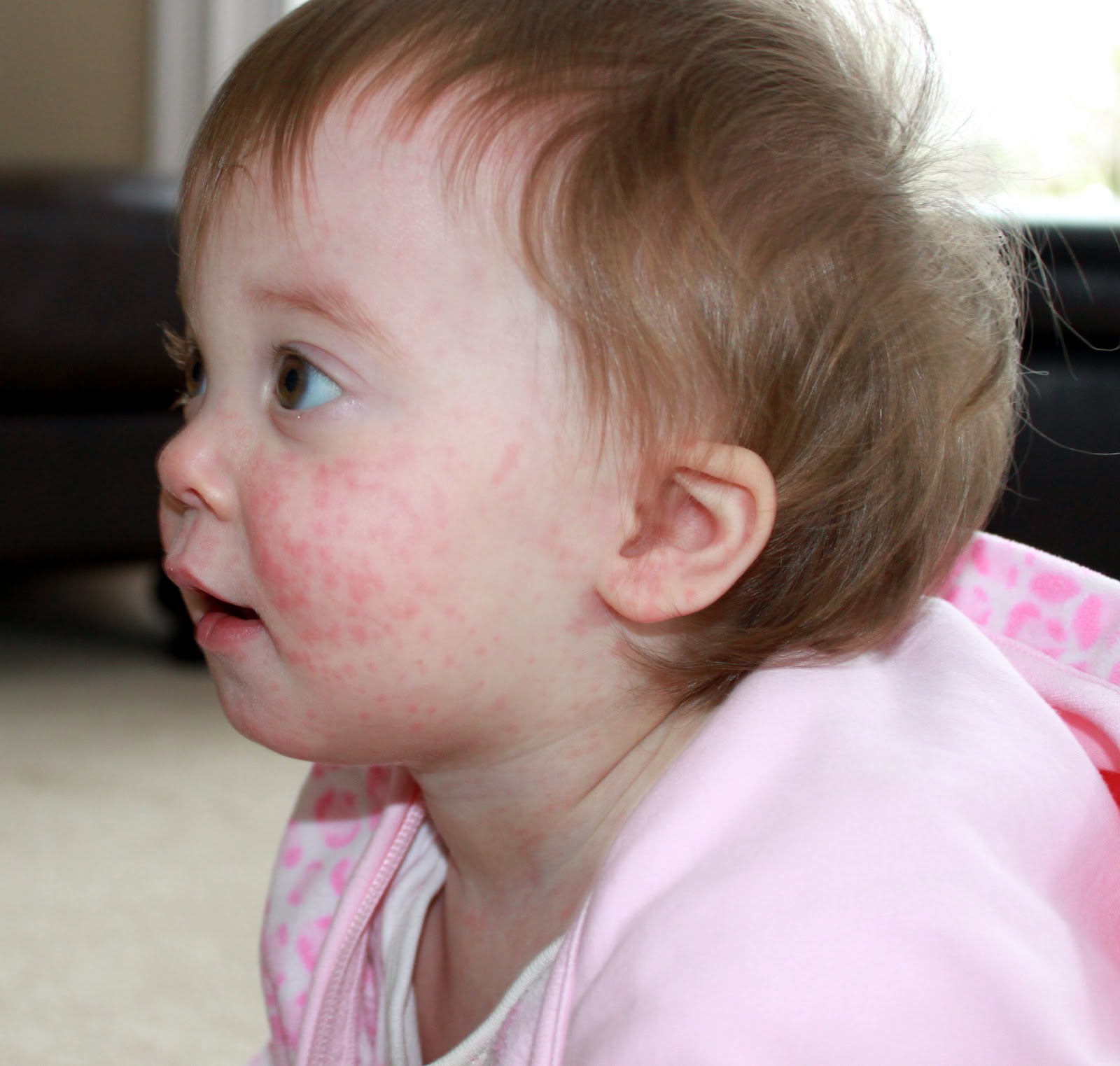 Аллергия у ребенка на апельсин фото