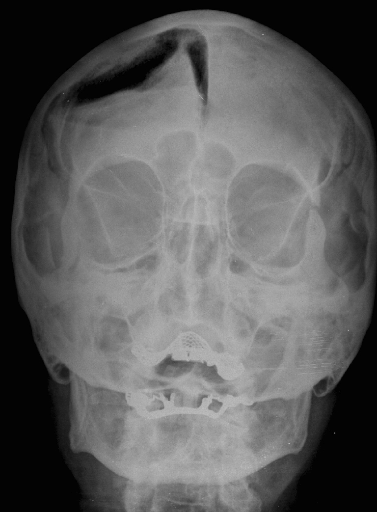Черепно мозговую кость. Перелом костей основания черепа рентген. Оскольчатый перелом черепа рентген. ЧМТ перелом свода черепа. Оскольчатый перелом затылочной кости.