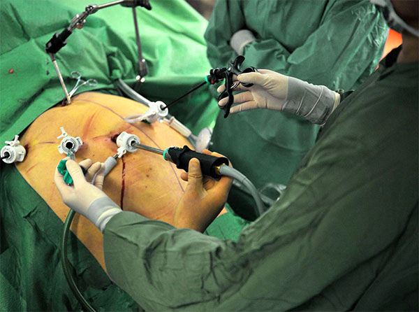 Операция при язве 12-перстной кишки