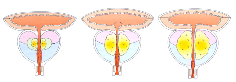 Стадии дгпж. Аденома простаты 3 степени. ДГПЖ предстательной железы что это такое. Доброкачественная гиперплазия предстательной железы стадии. Доброкачественная гиперплазия предстательной железы в стадии 3а.