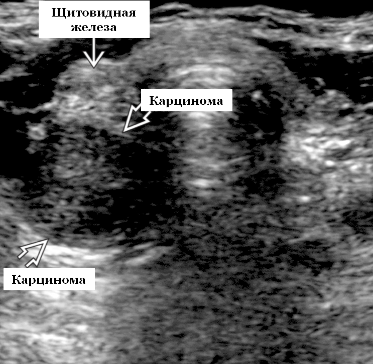 Ультразвуковое исследование паращитовидной железы. Аденома щитовидной железы на УЗИ.