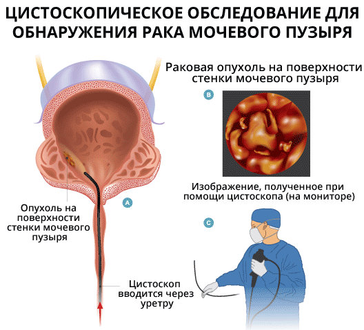 Рак мочевого пузыря симптомы. Алгоритм диагностики опухолей мочевого пузыря. Цитология опухоли мочевого пузыря. Обследование при опухолях мочевого пузыря. Цитологическое исследование мочевого пузыря.