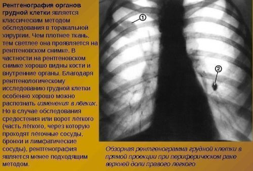 Рентген легких