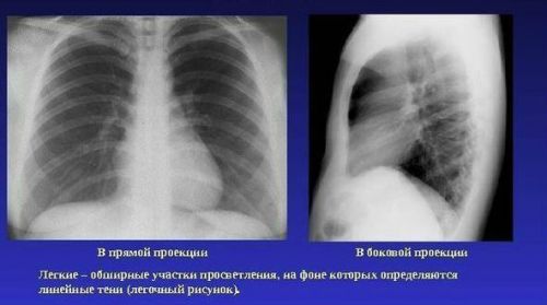 Рентген легких в 2 проекциях