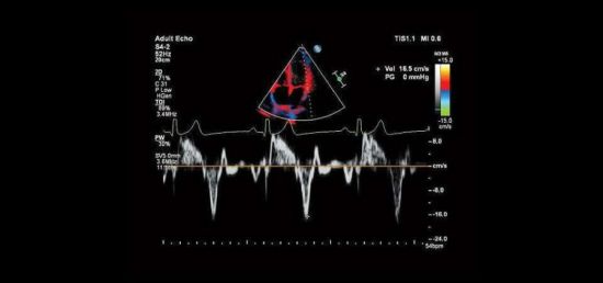 УЗИ сердца с допплерографией
