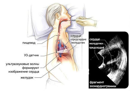 Чреспищеводная эхография