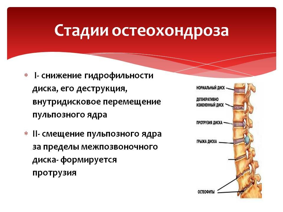 Мр картина остеохондроза шейного отдела позвоночника