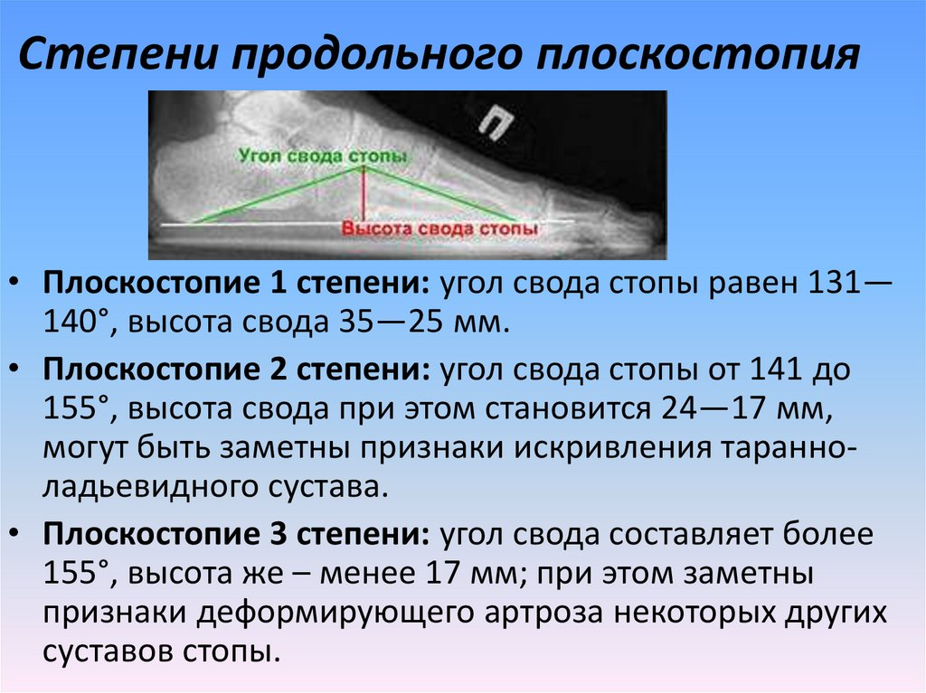 Плоскостопие рентген схема