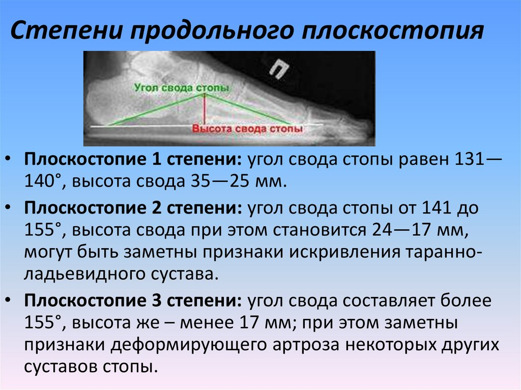 Третью степень плоскостопия. Угол продольного свода стопы 3 степени. Продольное плоскостопие рентген степени. Угол свода стопы при плоскостопии 1 степени. Продольное плоскостопие степени по рентгену.