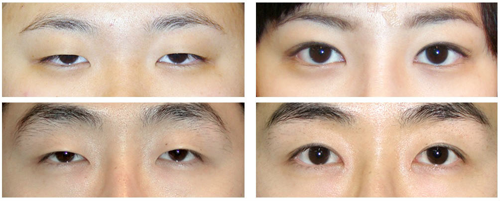 Узкий разрез глаз какая раса. Блефаропластика монголоидных глаз. Блефаропластика азиатских век. Блефаропластика азиатских глаз. Разрез глаз у азиатов.