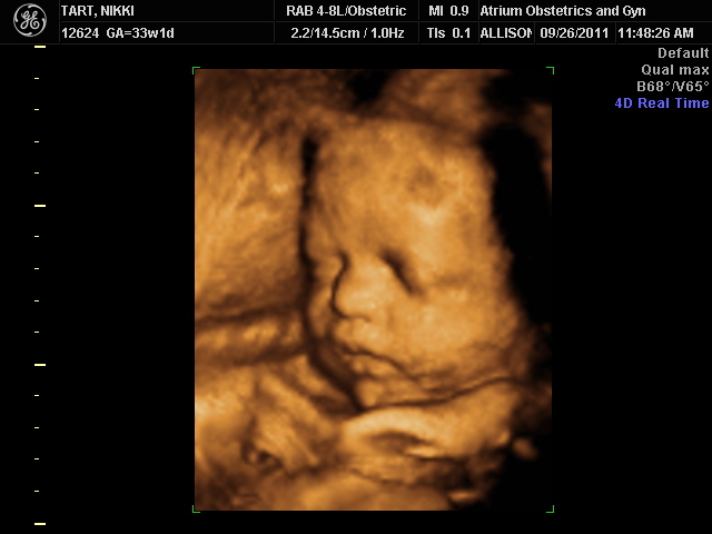 Как выглядит 23 неделя беременности. УЗИ ребенка на 32 неделе беременности. 33 Неделя беременности фото плода УЗИ. УЗИ плода 32-33 недели беременности. УЗИ В 32-33 недели беременности фото.
