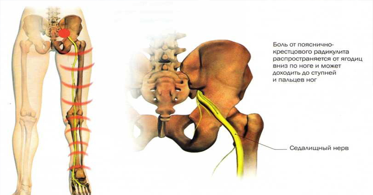 Защемление в поясничном отделе позвоночника. Пояснично-крестцовый радикулит симптомы. Радикулопатия пояснично-крестцового. Седалищный нерв анатомия. Пояснично-крестцовый отдел позвоночника защемление нерва.