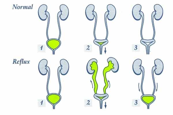 Пузырно мочеточниковый рефлюкс презентация