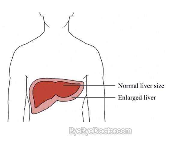 enlarged liver pictures