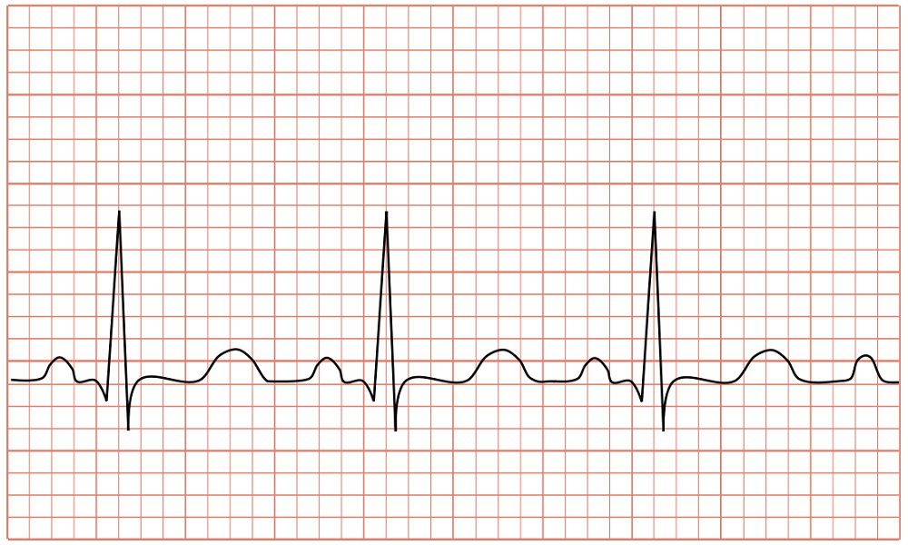 Синусовая тахикардия на ЭКГ