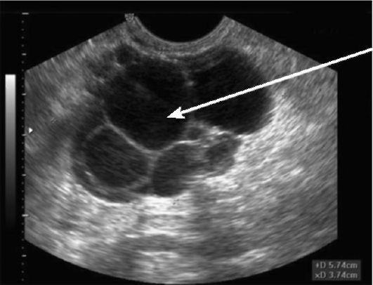 Параовариальная киста на узи фото
