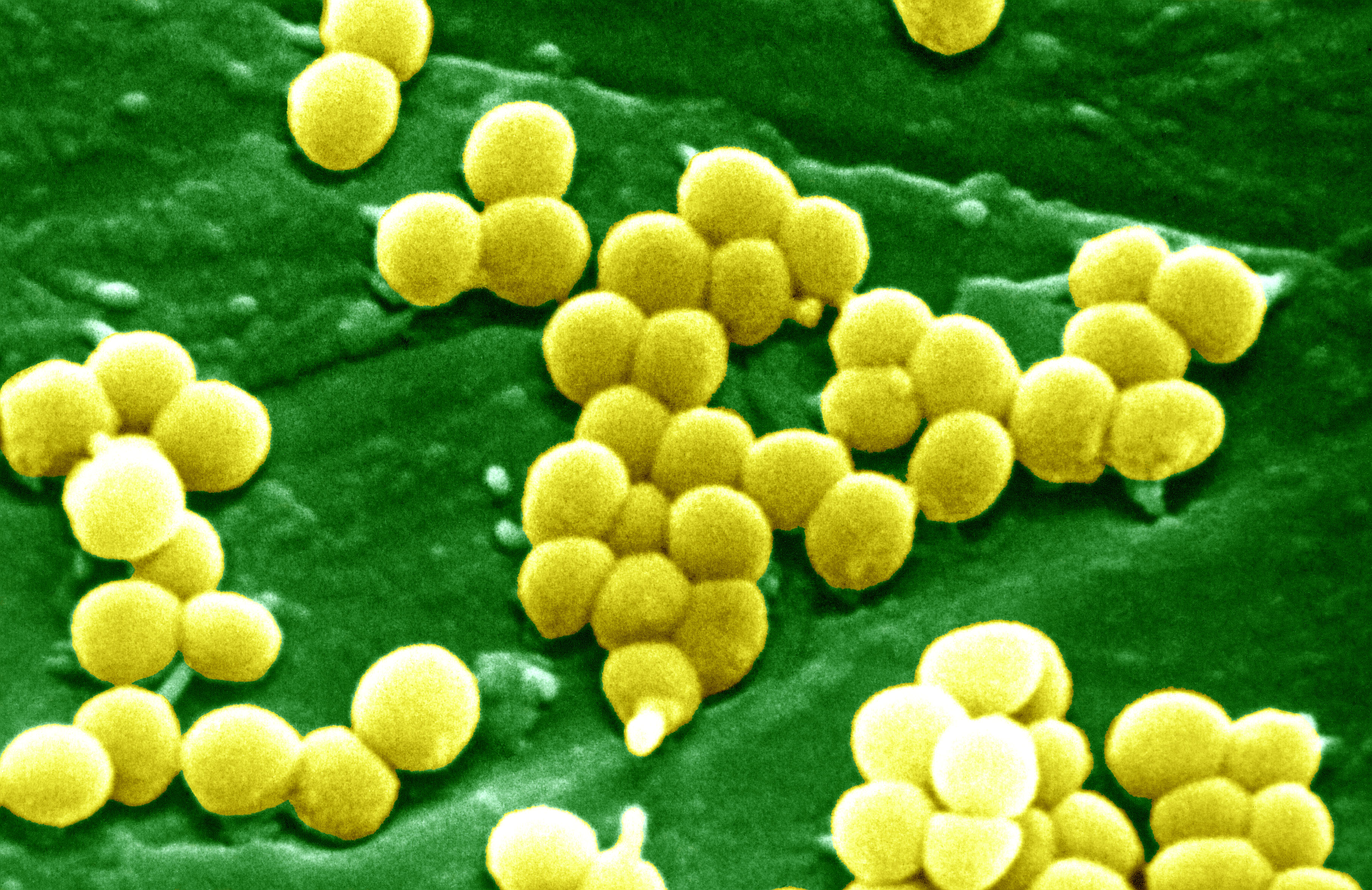 Staphylococcus aureus 4. S. aureus золотистый стафилококк. Стафилококк золотистый у новорожденных. Метициллин-резистентный золотистый стафилококк. Золотой стафилококк под микроскопом.