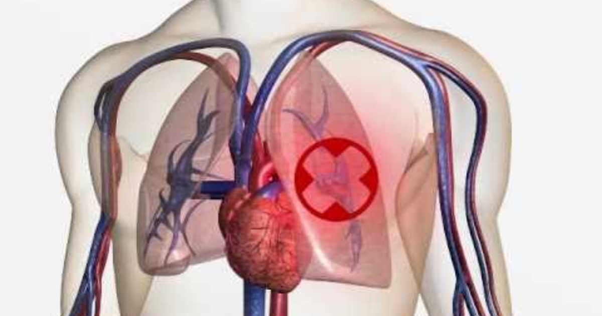 Тромбозы и эмболии артерий. Тромбоэмболия легочной артерии. Эмболия тромбом легочной артерии (Тэла);. Тромбоэмболия лёгочной артерии сердце.