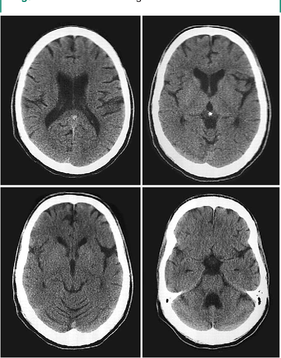 Патологии на мрт. Кт томограмма головного мозга. Компьютерная томография кт головного мозга. Рентгеновская компьютерная томография головного мозга. Компьютерная томография головного мозга норма.
