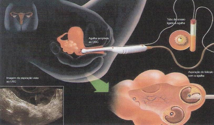 Подсаживали 2 эмбриона. УЗИ после переноса 2 эмбрионов при эко. Криоперенос эмбриона в матку. Эко пересадка эмбриона в матку. Матка после подсадки эмбрионов.